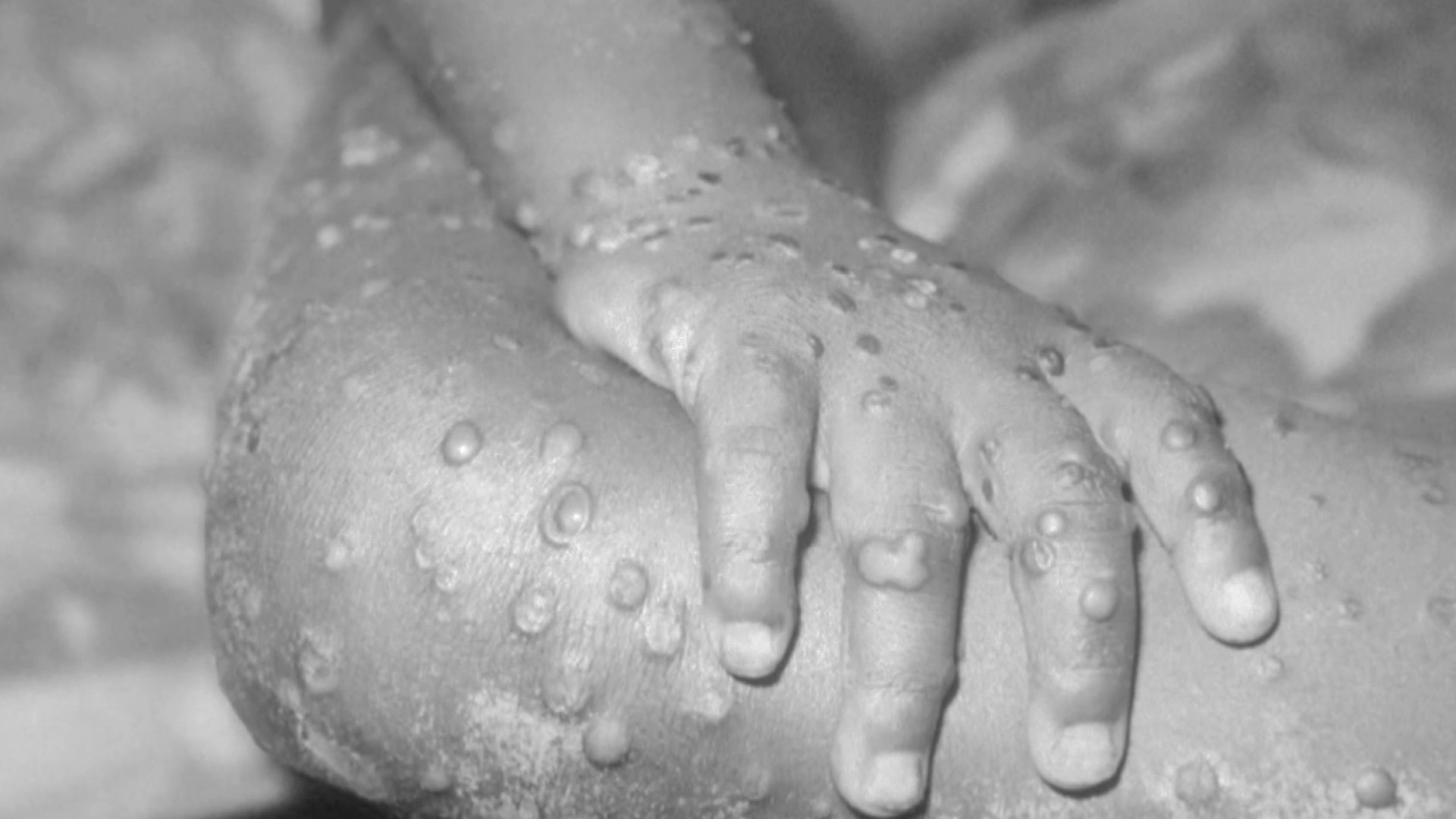 Monkeypox: What are the causes and symptoms of infection?